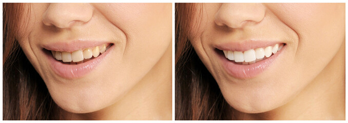 Woman teeth before and after whitening