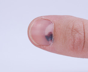 Subungual hematoma under nail