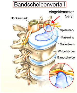 Bandscheibenvorfall.Eingeklemmter Nerv