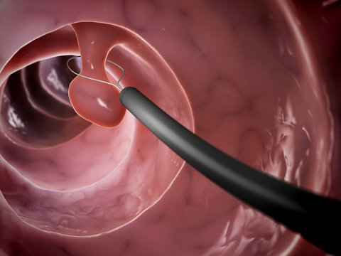 3d rendered illustration of a polyp removal
