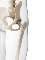 3d rendered illustration of a hip replacement