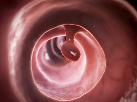 3d rendered illustration of a colon polyp