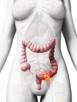 3d rendered illustration of colon cancer