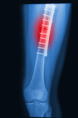 X- Rays image broken knee joint with plate and screw