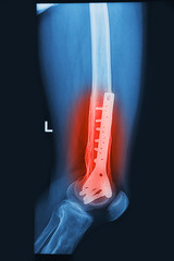 X- Rays image broken knee joint with plate and screw