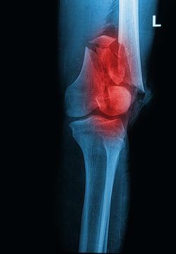 Broken human thigh x-rays image ,lelf leg fracture