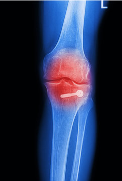 x ray image painful of knee joint