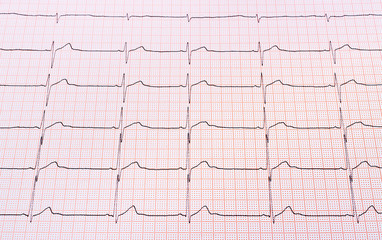 Heart rhythm chart