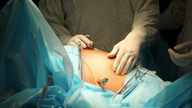 Laparoscopic surgery of the abdomen 3