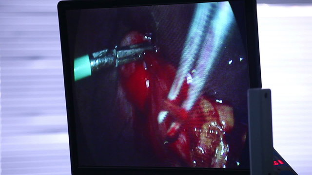 Laparoscopic Surgery On The Monitor 2