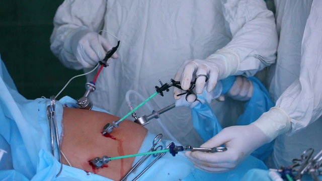 Laparoscopic surgery of the abdomen  5