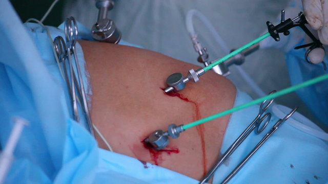 Laparoscopic surgery of the abdomen 6