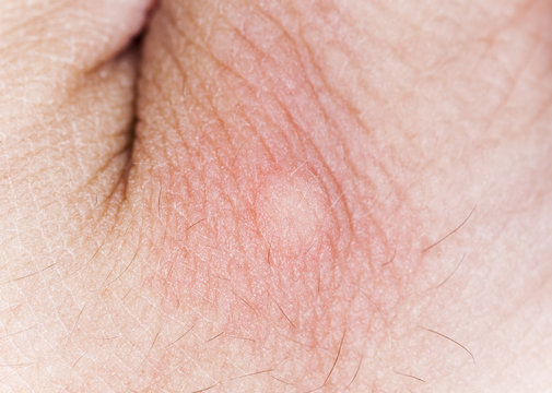 Mosquito bite on human hand, macro photo