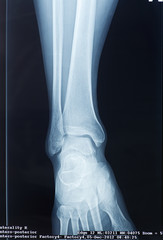 X-rays of leg fracture patients