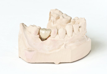 Zahnersatz - Implantat