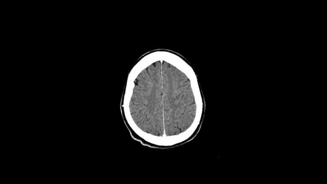 X-ray of Brain CT CAT Scan at 2 speeds