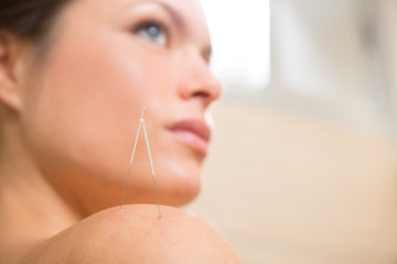 Acupuncture needle pricking on woman shoulder