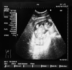 Ultrasound Baby