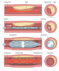 Medical illustration showing coronary angioplasty with balloon expansion and stent placement to open a narrowed artery and restore normal blood flow.