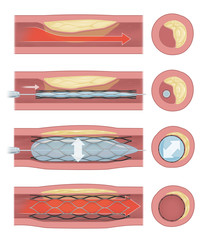 Medical illustration diagram showing the process of coronary angioplasty with balloon expansion and stent placement to restore blood flow in a narrowed artery. 