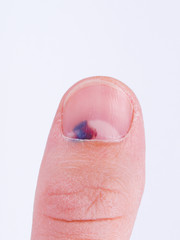 Subungual hematoma under nail