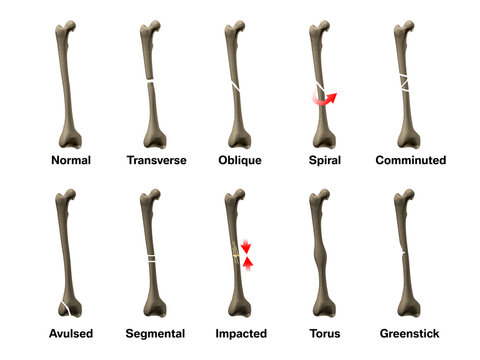 All Types of Bone Fractures