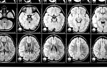 X-ray image of the brain computed tomography