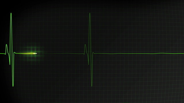 Normal heartbeat pulse monitored on a hospital EKG