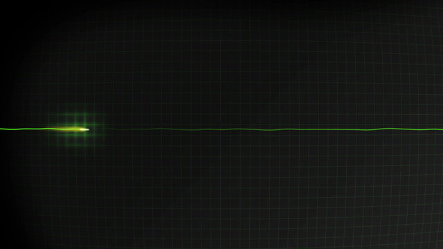 No heartbeat or pulse monitored on a hospital EKG