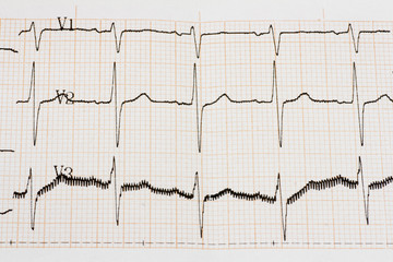 Arrhythmia