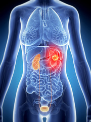 3d rendered illustration of female kidney cancer