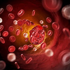 3d rendered illustration of arteriosklerosis