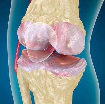 Osteoarthritis : Knee