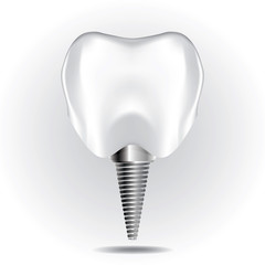 Tooth Implant Set 1