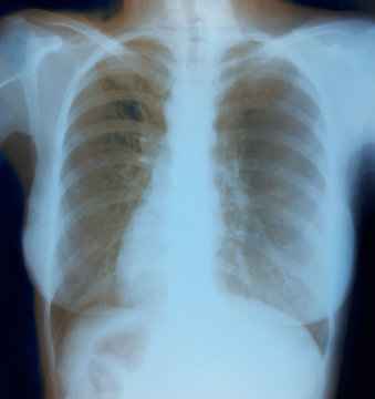 Chest X-ray image of healthy woman