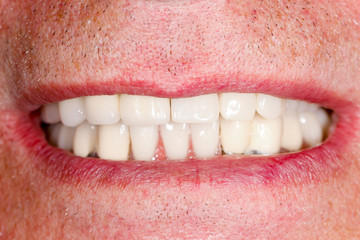 Obraz premium Prosthesis