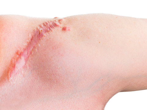 Narbe auf auf einer Schulter