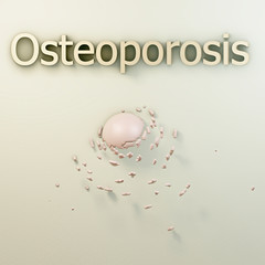 Osteoporosis - 3d Render