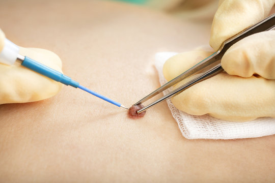 Radio wave electrocoagulation birthmark remove method