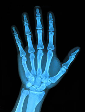Hand x-ray