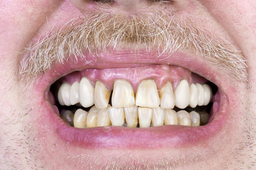 Yellow teeth  studio shot