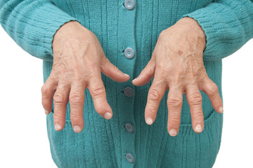 Rheumatoid arthritis of the fingers