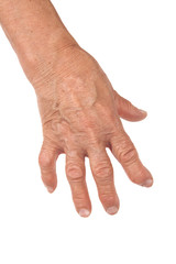 Old Woman's Hand Deformed From Rheumatoid Arthritis