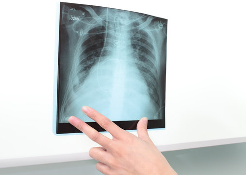 Chest X-ray to negatoscope. Analysis of the diagnostic data.