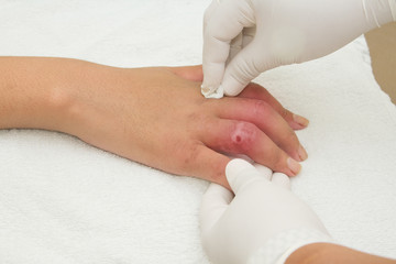 Hand Injury  after car accident severed  closed fracture 2-4 fin