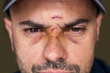 Black eyes of a injured man