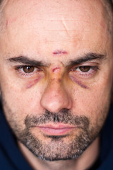 Injured man with black eyes