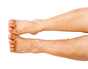 Lower extremity disease