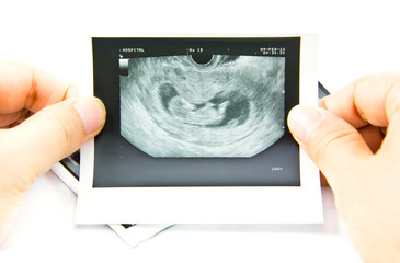 12 weeks baby ultrasound Image