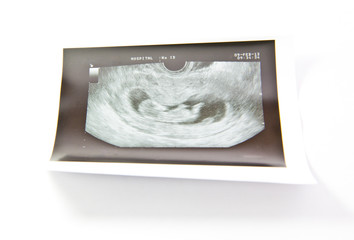 12 weeks baby ultrasound Image